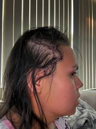 I wonder why some drs do different incisions?i feel like mine is so big! My  dr also used glue instead of staples