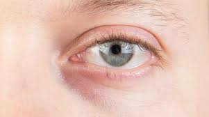 Blaue Augenringe Ursachen Und Was Wirklich Hilft