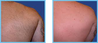 Suitable for men and women, all skin types. Laser Hair Removal London Courthouse Clinics London