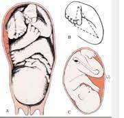 Clubfoot is treated with manipulation by podiatrists, physiotherapists, orthopedic surgeons, specialist ponseti nurses, or. Introduction To Clubfoot Physiopedia