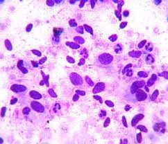 The biopsy shows a cellular spindle cell. A Very Large Malignant Phyllodes Tumor With Skin Ulceration And Nipple Areola Complex Involvement Still A Reality Springerlink