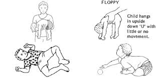 Image result for Floppy Infant