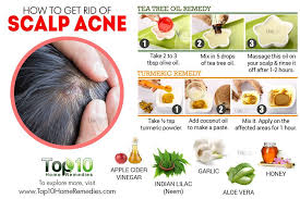 Image Result For Bumps On Scalp Pictures Scalp Acne Pimples On Scalp Natural Acne Remedies