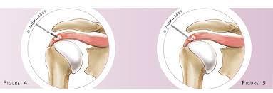 Image result for Rotator Cuff Calcification