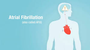 Image result for Atrial Fibrillation