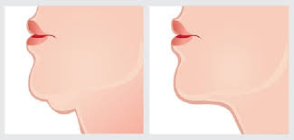 La text neck (ou tech neck), qui. Affiner Un Double Menton Les Methodes De Medecine Esthetique Afme