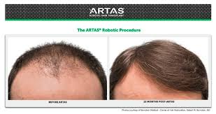 Male pattern hair loss is the leading cause of hair loss in men. Artas Ix