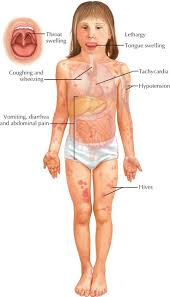 Image result for Anaphylaxis