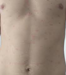 Apr 17, 2020 · lo más llamativo es que las marcas en la piel parecían aparecer y desaparecer, algo que no ocurre con otros sarpullidos asociados a infecciones virales como la varicela, el sarampión o incluso. Las Cinco Lesiones En La Piel Que Se Vinculan Con El Coronavirus