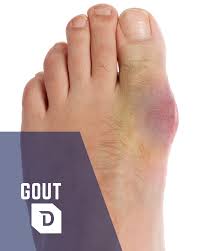 Image result for gout symptoms toe