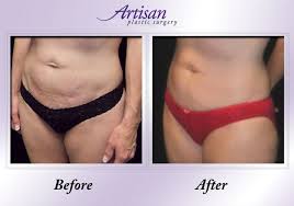 Average cost of a mommy makeover. Mommy Makeover Pittsburgh Greensburg Pa Artisan Plastic Surgery