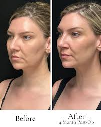 Before and after, Kayla's septoplasty transformation. Better breathing,  natural balance, confident results. #Septoplasty #BeforeAndAfter  #FacialBalance #AestheticMedicine #RealResults #DermacareMedicalAesthetics  #SanDiegoAesthetics #TransformationStory ...