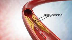 Image result for Hypertriglyceridemia