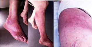 Chronic Lyme Borreliosis Associated With Minimal Change Glomerular Disease A Case Report Bmc Nephrology Full Text