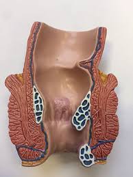 Image result for Hemorrhoid