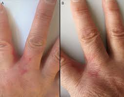 Image result for Erysipeloid