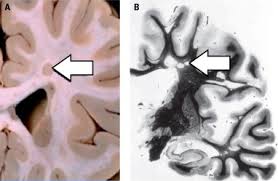 Esclerosis multiple la esclerosis múltiple (em) es la más común de las enfermedades inflamatorias que dañan la cubierta de las fibras nerviosas (mielina) del sistema nervioso central (snc). Esclerosis Multiple Sciencedirect