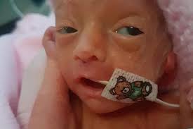 Scots baby girl born at just 28 weeks was so small…