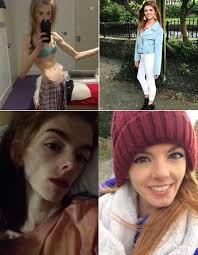 21-letnia dziewczyna jadła tylko jedną kanapkę co pięć dni i w jej wieku  ważyła 30 kg. Przypominała szkielet pokryty skórą i miała straszny lęk  przed jedzeniem. Tak się zmieniła Anna Windley w