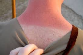 Gigaguenstig.de has been visited by 10k+ users in the past month Anatomy Of A Sunburn A Timeline Of Dermatological Destruction
