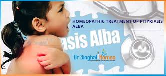 Tinea versicolour/ pityriasis versicolour is a fungal infection caused by malassezia. Homeopathic Treatment Of Pityriasis Alba Dr Singhal Homeo