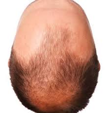 Si definisce autologo perché i capelli trapiantati sono prelevati dal . Trapianto Capelli Verona Tecnica Autotrapianto Foto E Costi Hsd