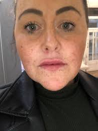 My lips exploded with pus after £60 botched fillers pierced a blood vessel  and left me permanently disfigured