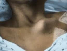 5 ways to get sexy, defined collarbones. Sternoclavicular Sc Joint Disorders Orthoinfo Aaos