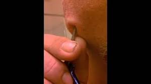 Mehr zu symptomen, diagnose, behandlung, komplikationen, ursachen und symptome und verlauf typische symptome des nasenfurunkels: Ran An Den Eiter Mann Offnet Eigenhandig Abszess Am Kiefer Zwp Online Das Nachrichtenportal Fur Die Dentalbranche