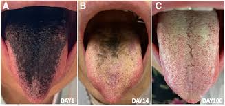 Image result for black hairy tongue symptoms