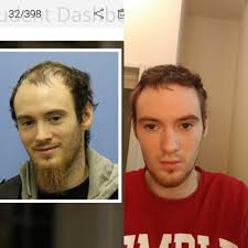 8, 9, 10 (like baldness, androgens are often blamed for prostate enlargement. The Relationship Between Caffeine Growth And Cox Inhibition Page 3 Hairlosstalk Forums
