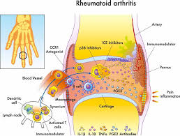 Acupuncture Alleviates Rheumatoid Arthritis Swelling And Pain