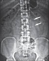 The transverse foramen is an opening on each of the transverse processes of the cervical spine which gives passage to the vertebral artery and vein and a sympathetic nerve plexus. Pitfalls In The Radiographic Diagnosis Of The Transverse Processes Fracture Of The Lumbar Vertebrae Hegde Kv Umamaheswara Rv Agrawal A J Orthop Allied Sci