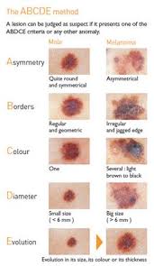The size is larger than a pencil eraser (6 millimeters). What Does Abcde And Skin Cancer Mean To A Dermatologist Edmonton Dermatology