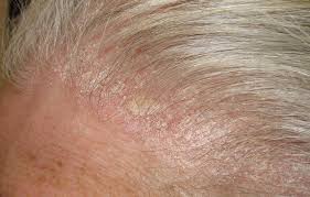 Image result for white scabs on the head in children