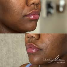 Schedule your appointment with Jamie Mora, PA-C @Studiophilly Link in bio  267-586-4978 Hablo Español 🇨🇴 Treatments/Pricing -SKINVIVE