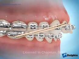 How Orthodontic Rubber Bands Work This Is An Example Of A Way That You May Have To Wear Your Rubber Ban Dental Braces Orthodontic Rubber Bands Orthodontics
