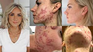 Check spelling or type a new query. How I Cured My Adult Hormonal Cystic Acne Naturally No Accutane Youtube