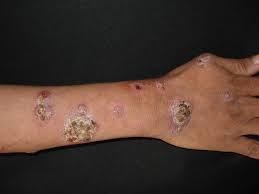 Image result for Nodular Lymphangitis
