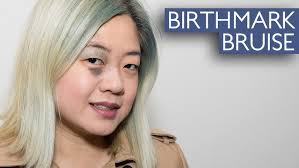 Woman Born With Birthmark