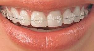 Braket Cesitleri Ortodonti Braket Disle Ilgili
