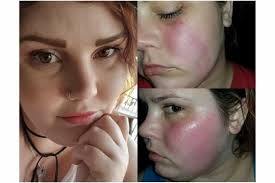 Fundraiser by Melissa Jones Hostetler : Sarah's UCLA Surgery Expense & Post  Op Fund