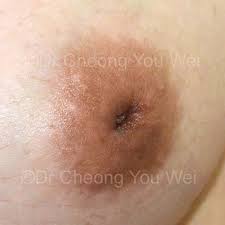 Image result for Nipple Inversion