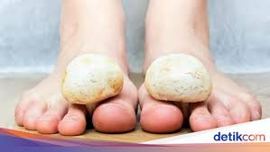 Kondisi medis yang mendasari kondisi medis ini dapat meliputi penyakit ginjal, anemia, diabetes, penyakit jantung, dll. Cara Aman Atasi Berbagai Kondisi Kuku Kaki Lepas Maupun Berdarah