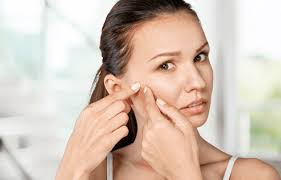 Black Peel Treatment for Acne & Scars