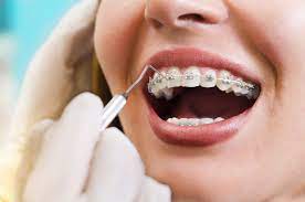 Removes harmful plaque · removes harmful plaque How To Stop Braces Pain A Guide