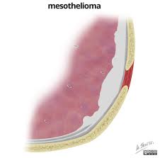 Mesothelioma Radiology Reference Article Radiopaedia Org