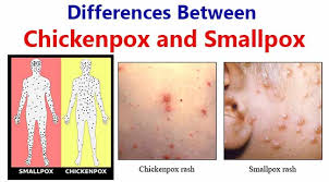 Image result for Smallpox