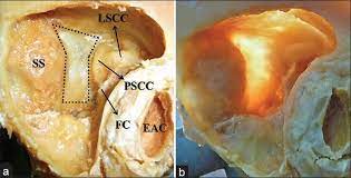 Transmastoid view of left lateral labyrinth and endolymphatic sac. Qualitative Analysis Of Trautmann S Triangle In The Medial Group A Download Scientific Diagram