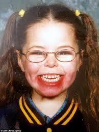 Tasmanian woman Tamara Bennett whose lips will never stop growing due to  rare condition